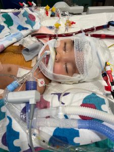 Young child with head bandages and medical tubes connected to a ventilator, lying on a hospital bed with monitoring equipment.