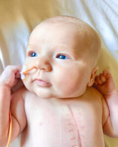 Baby CeCe. Baby with blue eyes lies on a bed with a feeding tube and visible chest surgery scar.